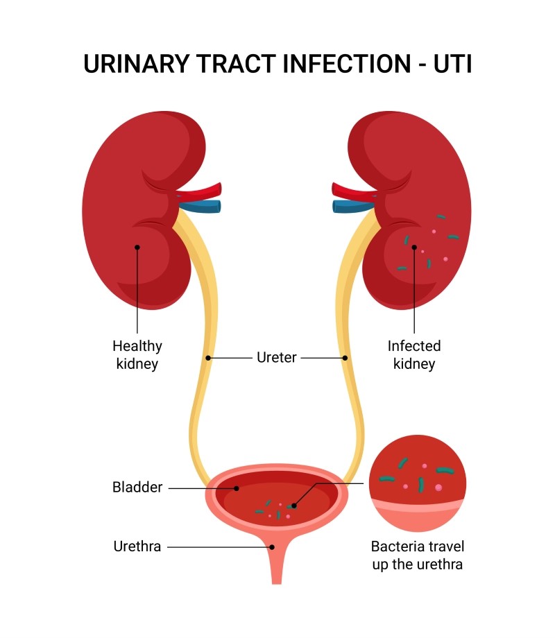 Urinary Tract Infection